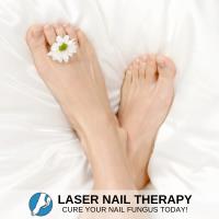 Laser Nail Therapy - Weymouth image 2